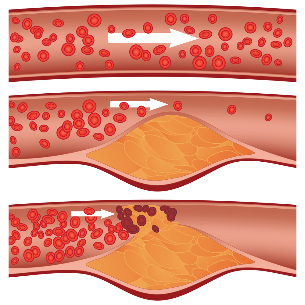 Cholesterol xấu gây tắc mạch máu, có thể dẫn đến xơ vữa động mạch, hay nặng hơn là nhồi máu cơ tim hay đột quỵ